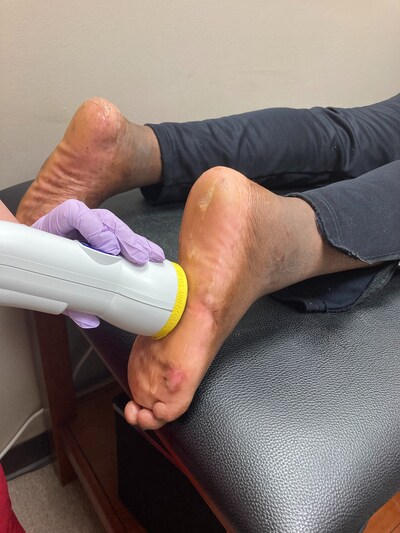 Softwave TRT treatment on the feet.