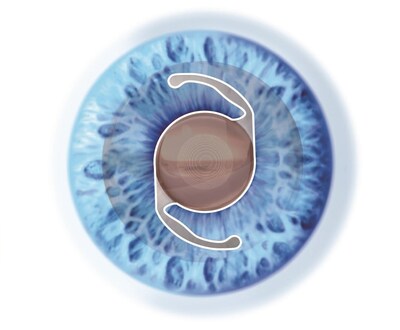 IOL Lens IOL Lens