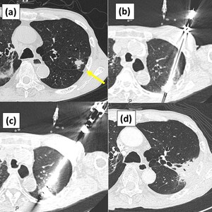 IceCure's Cryoablation System Combined with Radiation Therapy Successfully Treats Non-Small Cell Lung Cancer (NSCLC) with 92% Disease-Specific 5-year Survival