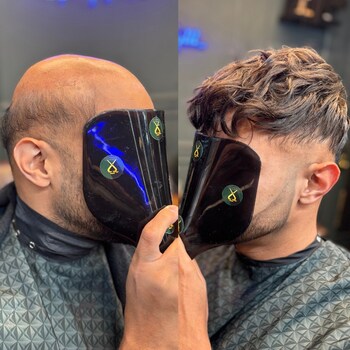 Before & After Hair Replacement