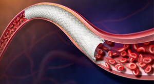 BD Achieves Milestone in AGILITY Study of Revello™ Vascular Covered Stent for Treatment of Peripheral Artery Disease