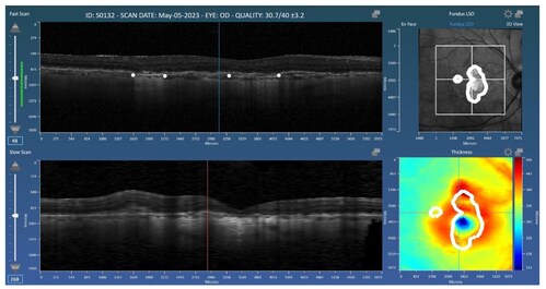 Representation of the Orion application by Voxeleron, a Voiant Company, used for the grading of geographic atrophy (GA)