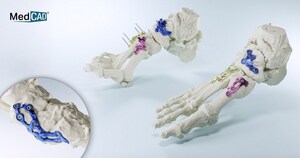 MedCAD's AccuStride™ Fixation Plates Receive 510(k) FDA Clearance to Complete Foot and Ankle System Offering