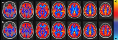 Mean cerebral blood flow (CBF) maps following the (A) peanut intervention and (B) control periods in adults (n = 31). CBF displayed in mL100 gmin (scale shown by color bar).