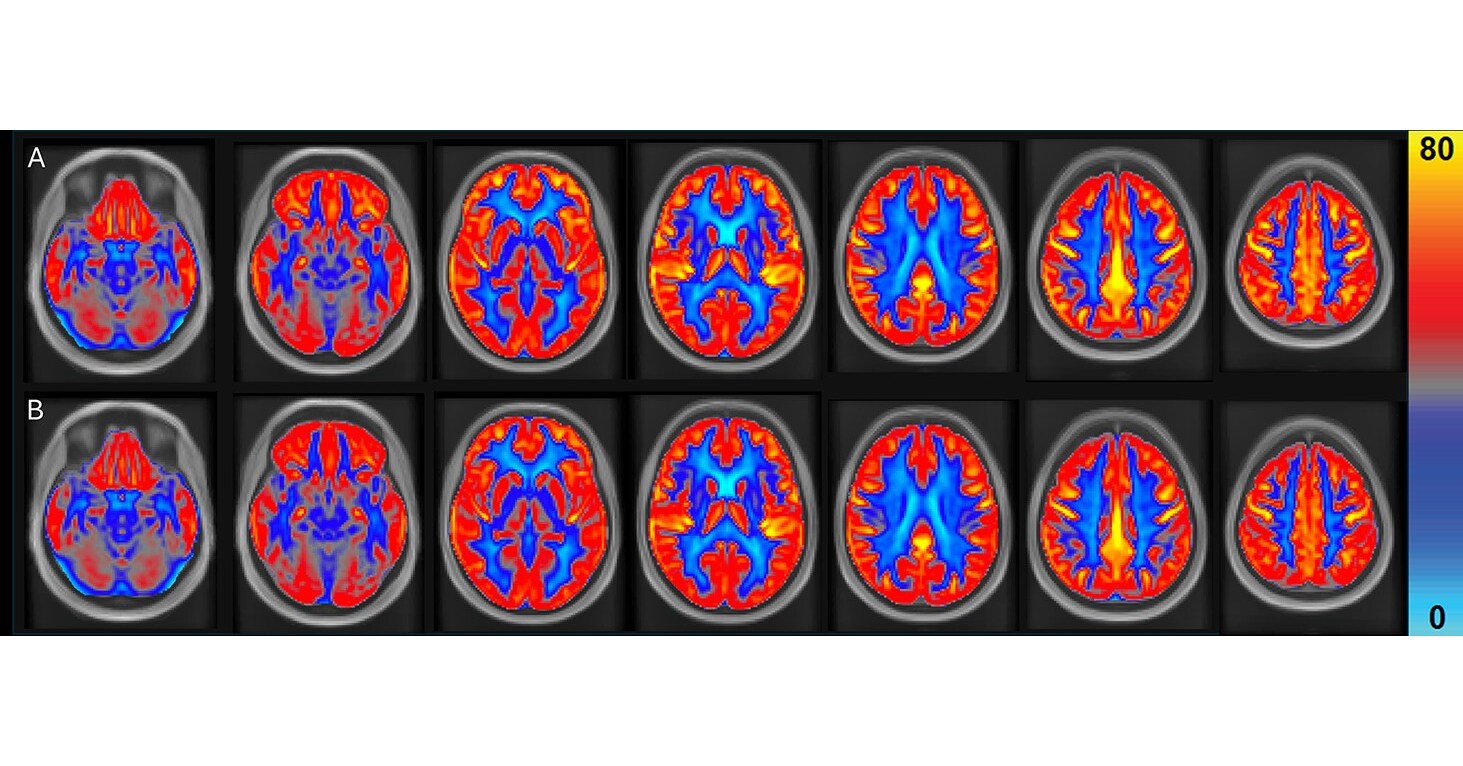 New Research Finds Dietary Intervention of Peanuts Improves Brain Vascular Function and Memory