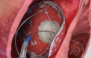 Allmed Solutions Achieves Landmark 'Needle-Stick' Heart Valve Replacement