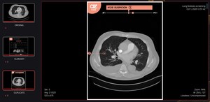 AZmed Expands Into CT Imaging With CE-Marked AZnod, An AI Tool for Lung Nodule Detection and the First Product in the Rayscan® Line