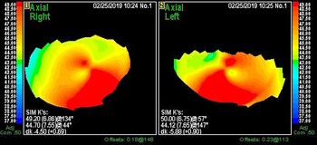 Keratoconus diagnosed with corneal topography