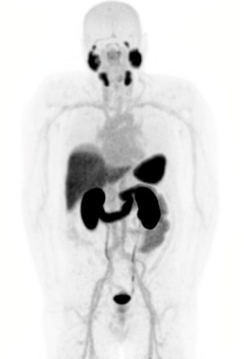Lesion uptake of 64Cu-SAR-bisPSMA positron emission tomography (PET) at baseline (left image) and following two cycles of 67Cu-SAR-bisPSMA (8 GBq each; right image). PET image on the right was acquired 1 month after the 2nd cycle. Coloured arrows indicate representative metastatic bone lesions within each region: red – skull; blue – ribs and sternum; orange – spine; green – pelvis. Images shown as maximum intensity projections.