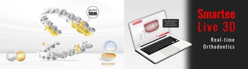 Smartee Sleep Aligners(Left), Smartee Live 3D (Right)