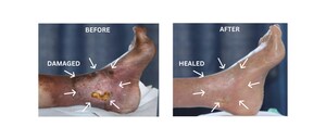 First Peer-Reviewed Study Shows Tissue Once Deemed Non-Salvageable Can Be Healed in Patients Facing Amputation