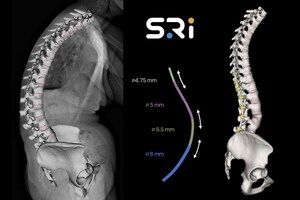 Notice of Allowability Issued for Variable-Dimension Fixation Rod and Implantable Stabilization System Expanding Use Specific to Patient Anatomy