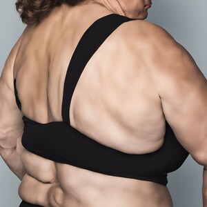 康霈 CBL-514 竇根氏症二期成果獲登國際權威期刊《JAAD International》