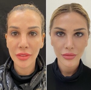 The Facelift That Doesn't Look Like a Facelift