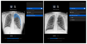 Manipal Hospitals Adopts Harrison.ai's chest X-ray AI to improve patient outcomes