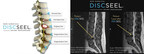 Patient Pre-DISCSEEL and 1 year after DISCSEEL procedure