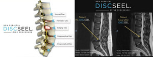 NYC Pain Management Doctors Introduce DISCSEEL® Procedure for Chronic Disc-Related Back Pain