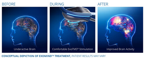 Conceptual Depiction of Exomind Treatment