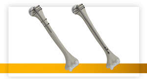 Stryker launches T2 Alpha Humerus Nailing System, supporting surgical workflow and care for complex fractures