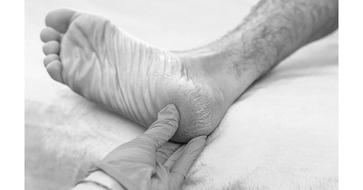 New Published Case Series Explores Umbilical Cord Tissue Allografts in Plantar Fascia Care