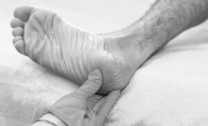 New Published Case Series Explores Umbilical Cord Tissue Allografts in Plantar Fascia Care