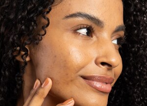 Glitter, maquiagem e calor: como evitar acne e irritações na pele durante o Carnaval