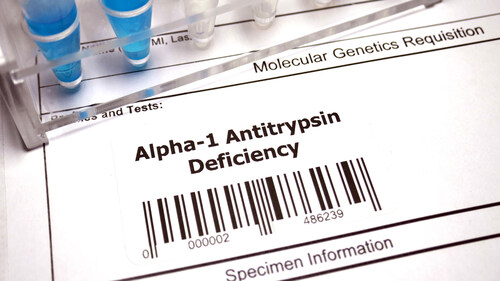 Alpha-1 Antitrypsin Deficiency is a rare genetic condition that affects patients' lungs and livers, sometimes requiring a lung or liver transplant to survive.