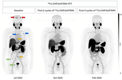 Figure 2. Lesion uptake of 64Cu-SAR-bisPSMA PET at baseline (left), following two cycles of 67Cu-SAR-bisPSMA (8 GBq each; centre) and following four cycles of 67Cu-SAR-bisPSMA (right). Coloured arrows indicate metastatic bone lesions within each region: red – skull; blue – ribs and sternum; orange – spine; green – pelvis. No detectable disease was observed on the post-treatment PET. Images are shown as maximum intensity projections. SUV: standardised uptake value. Figure 2. Lesion uptake of 64Cu-SAR-bisPSMA PET at baseline (left), following two cycles of 67Cu-SAR-bisPSMA (8 GBq each; centre) and following four cycles of 67Cu-SAR-bisPSMA (right). Coloured arrows indicate metastatic bone lesions within each region: red – skull; blue – ribs and sternum; orange – spine; green – pelvis. No detectable disease was observed on the post-treatment PET. Images are shown as maximum intensity projections. SUV: standardised uptake value.