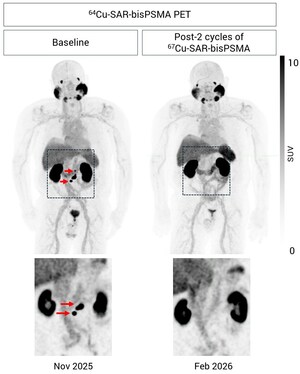 SECuRE trial update: Another participant with undetectable PSA &amp; negative PSMA PET