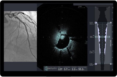 HF-OCT image of a coronary artery