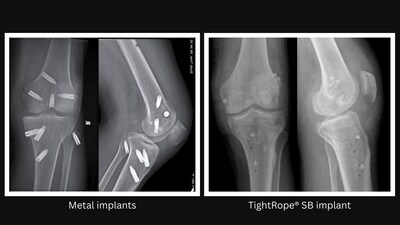 Soft button graft fixation after multiligament reconstruction procedures versus traditional metal implants