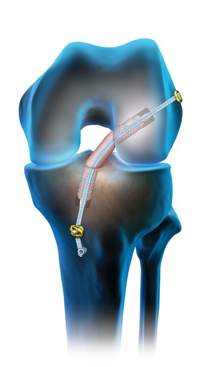 The TightRope® SB implant represents the evolution of Arthrex ACL technology, offering a fully all‑suture solution while maintaining the procedural flexibility and reproducibility surgeons expect. By eliminating rigid materials and preserving strong, adjustable fixation, the device expands graft-fixation options for both ACL reconstruction and repair.