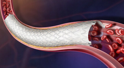 The Revello™ Vascular Covered Stent is a next-generation endovascular solution for the treatment of atherosclerotic lesions in the common and external iliac arteries.