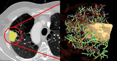 New AI Solution Helps Predict Which Lung Cancer Patients Will Benefit from Immunotherapy