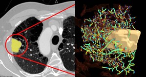 New AI Solution Helps Predict Which Lung Cancer Patients Will Benefit from Immunotherapy