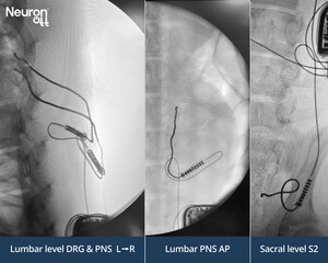 Neuronoff Demonstrates Multi-Site IPG Compatibility for Injectrode® Platform, Expanding Neuromodulation Beyond Spinal Cord Stimulation
