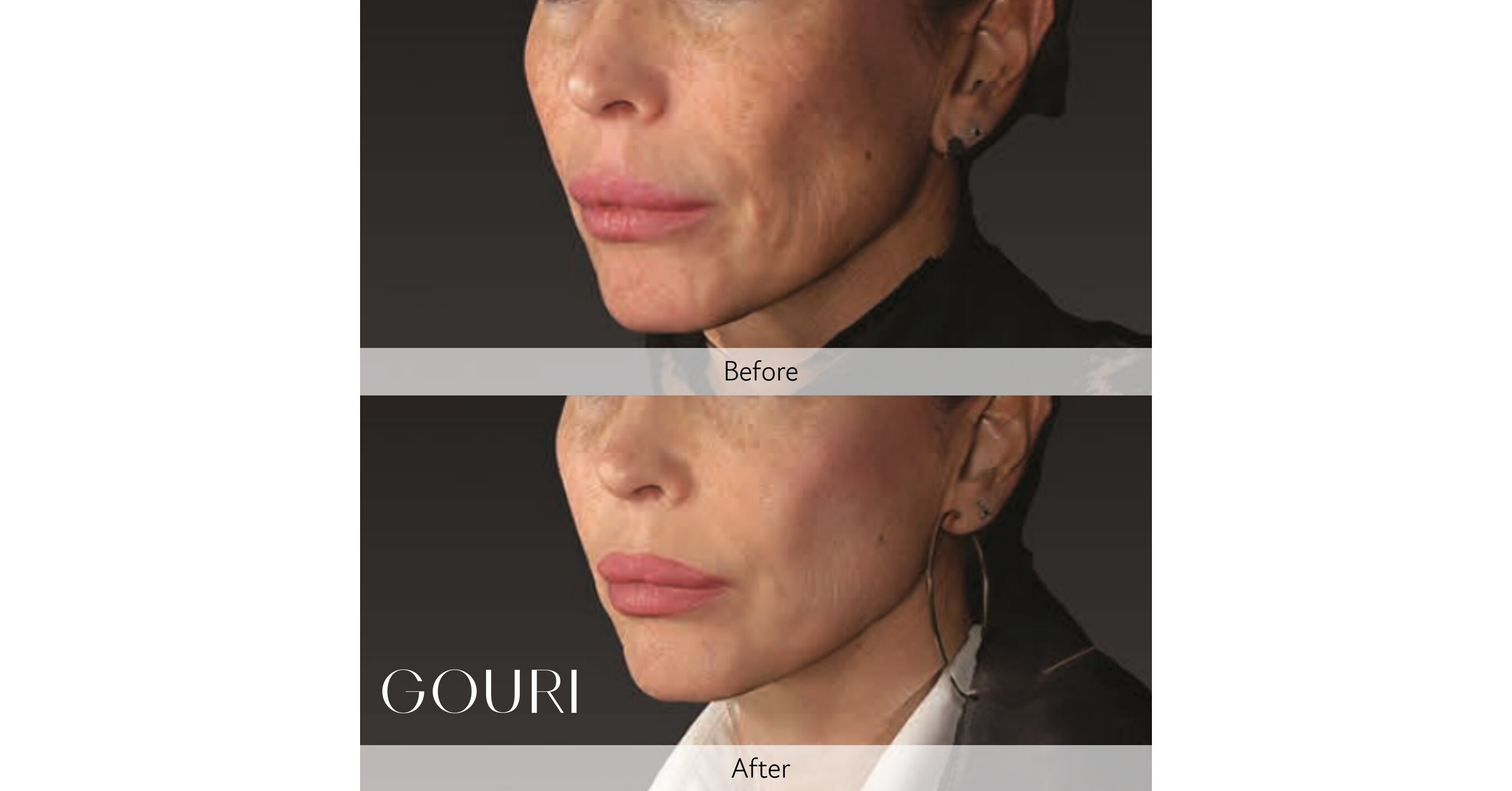 Global Aesthetic Trends Evolve Toward Anti-Sagging: The Expansion of the Structural Skin Laxity Improvement and Liquid Type PCL Collagen Stimulator Market