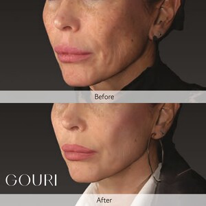 Global Aesthetic Trends Evolve Toward 'Anti-Sagging': The Expansion of the Structural Skin Laxity Improvement and Liquid Type PCL Collagen Stimulator Market