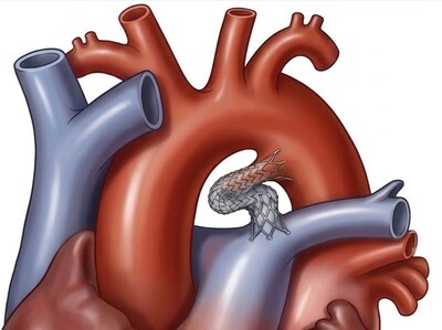 Lifeline stent in the ductus arteriosus, a blood vessel that connects the aorta and pulmonary arteries.