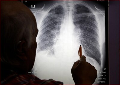Un médico señala una enfermedad pulmonar causada por la silicosis en una radiografía.   Themba Hadebe / AP