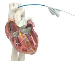 Medtronic OmniaSecure™ defibrillation lead is the first lead of its kind to receive FDA approval for conduction system pacing