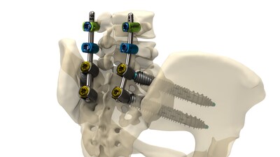 SIros-X™ System for SIJ Fusion and Pelvic Fixation