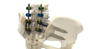 Genesys Spine Announces Launch of the SIros-X™ System for Sacroiliac Joint Fusion and Pelvic Fixation of Pedicle Screw Constructs