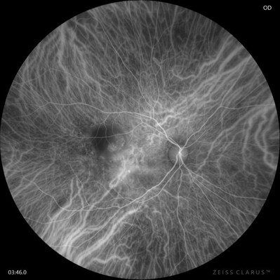 CLARUS® 700 from ZEISS with ICGA