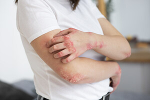 Why Chronic Eczema Can Last for Decades, and What a Recent Case Is Revealing