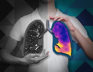 4DMedical receives CE Mark for CT:VQ™, enabling commercial launch across the European Union