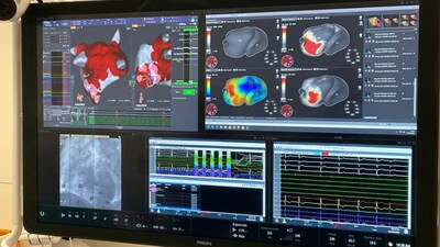 Corify Care Validates 4-D Global Cardiac Mapping