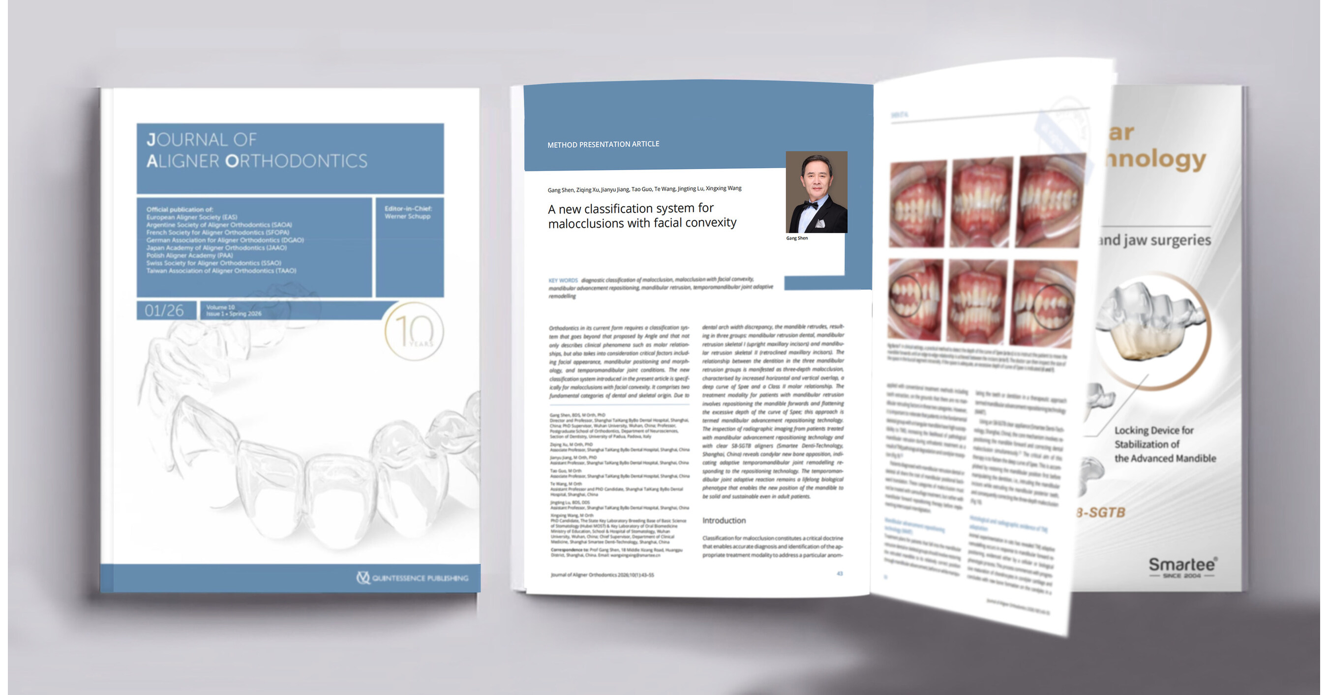 New Classification System of Malocclusions Published in the Journal of Aligner Orthodontics (JAO) by Prof. Gang Shens Team