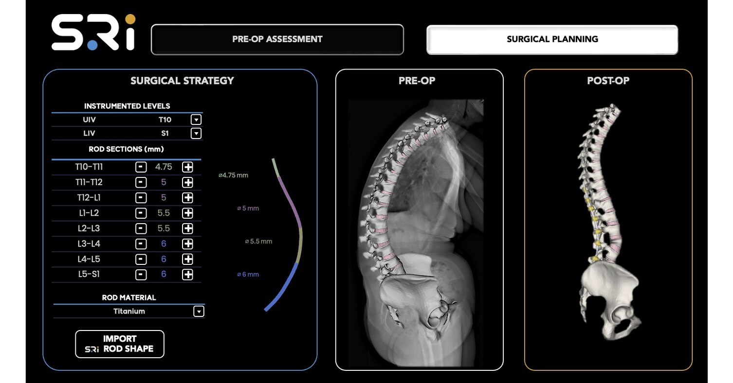 Unid Rods Spinal Resources, Inc. Awarded Second U.S. Patent for Multi-Diameter ...