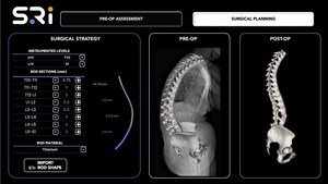 Spinal Resources, Inc. Awarded Second U.S. Patent for Multi-Diameter Spinal Fixation Rod, Establishing a Layered IP Position